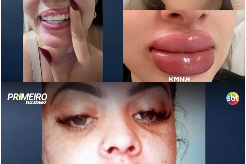 JOVEM TEM ROSTO DEFORMADO APÓS PREENCHIMENTO LABIAL CLANDESTINO E RELATA CENÁRIO DE HORROR COM INFECÇÃO GRAVE